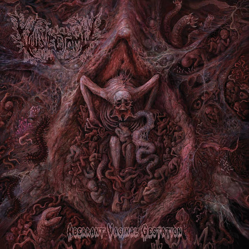 Vulvectomy - Aberrant Vaginal Gestation CD
