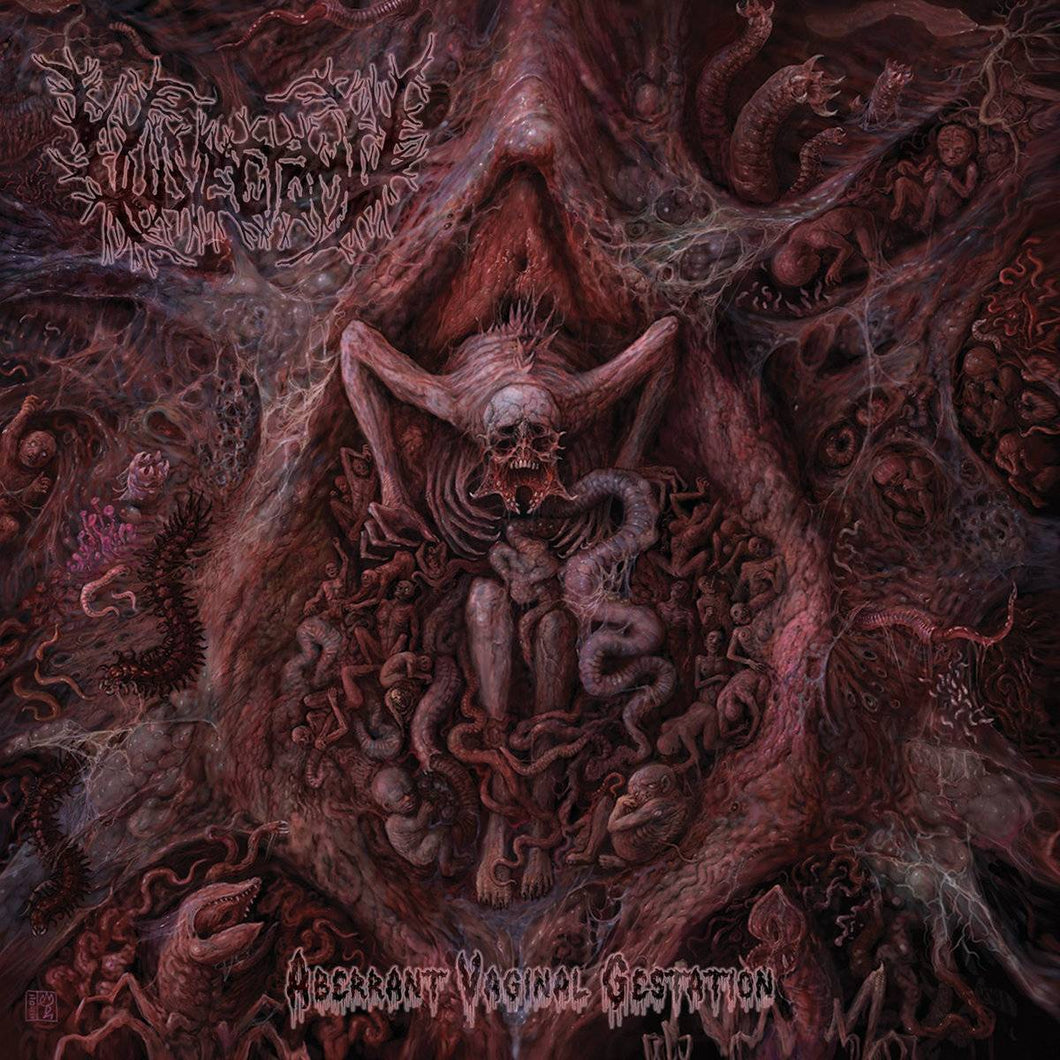 Vulvectomy - Aberrant Vaginal Gestation CD