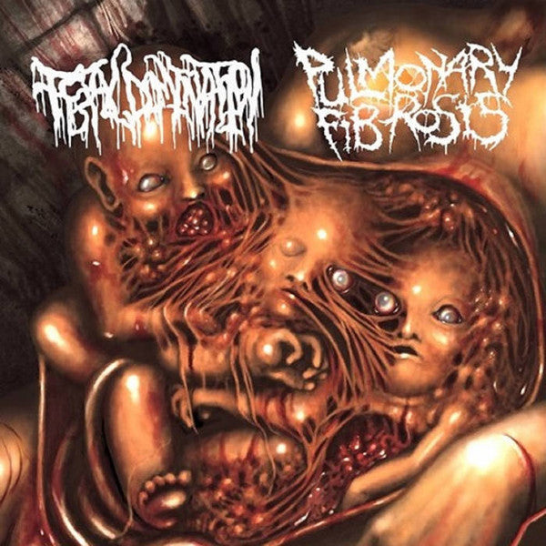 Pulmonary Fibrosis / Fetal Domination - S/T split CD